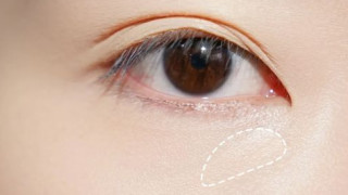 黑眼圈是怎么形成的 睡眠充足出现黑眼圈可能有这4种疾病